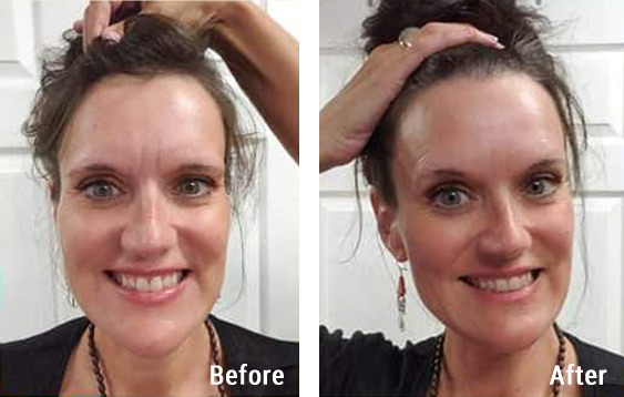 Before and after photos from an Access Energetic Facelift.