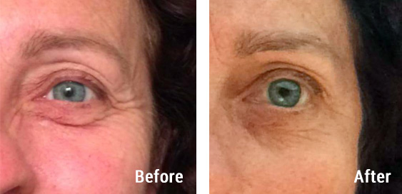 Before and after photos - Access Energetic Facelift